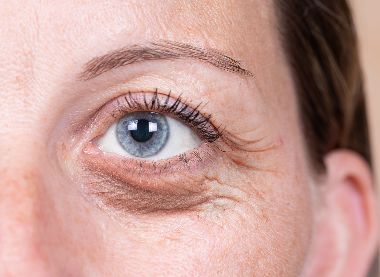 Blepharoplasty / Eyelid Lift